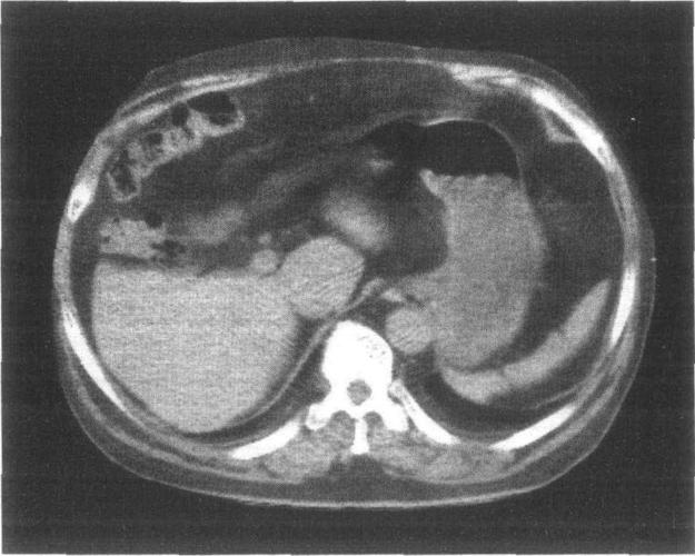 肝脏正常及变异ct图像