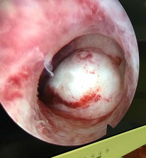 子宫粘膜下肌瘤