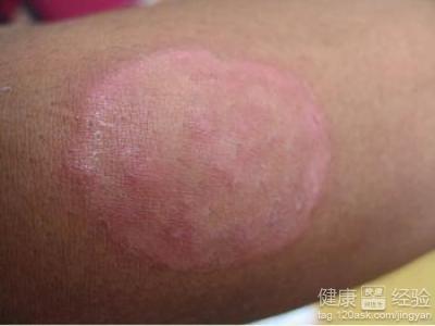 像是脚气,脚癣,手足癣等这些疾病都是皮肤感染真菌之后患上的,其实