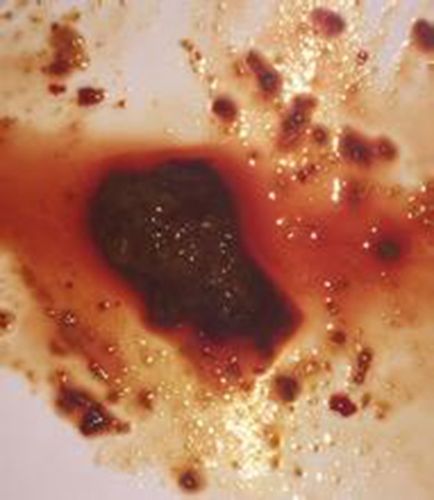 排便习惯改变应警惕结直肠肿瘤图片