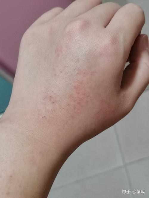 手背上有小红点突然