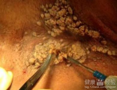尖锐湿疣疾病的发生是怎么引起的什么会导致尖锐湿疣