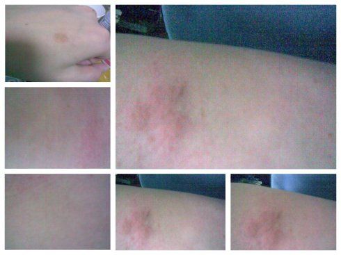 千辛万苦奇痒难耐,终于熬到漆疮第六天(有图有真相)