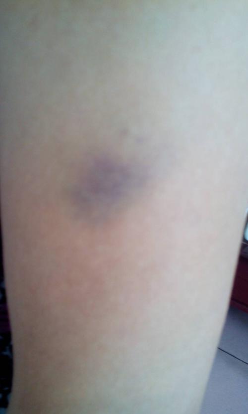 2013-07-26 房沛平 医师 没有外伤作用,腿,胳膊总是无缘无故的青一块