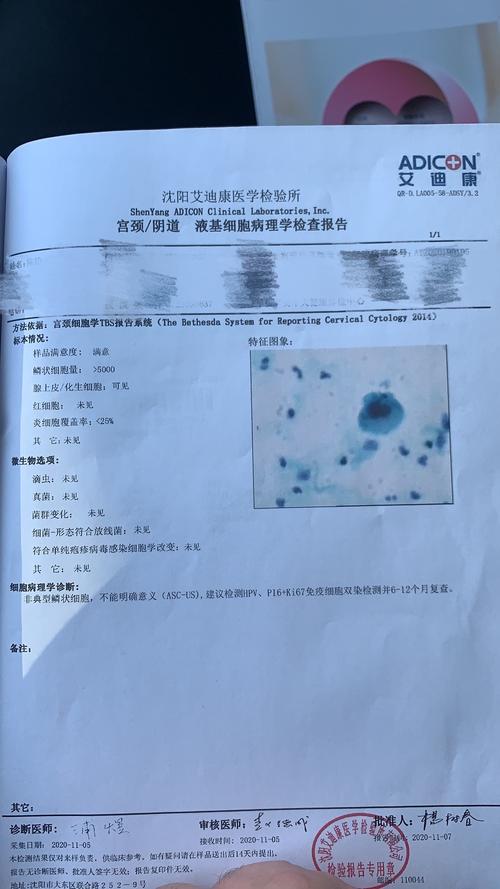 求助检查结果hpv全阴tct非典型性鳞状细胞ascus白带常规全阴清洁度四