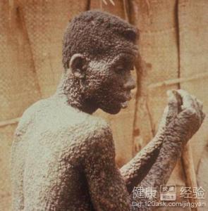 正文 天花是一种很折磨人的疾病,这个病与水痘有着不少相似的地方,有