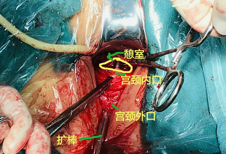 龙女周记(二)——浅谈子宫疤痕憩室