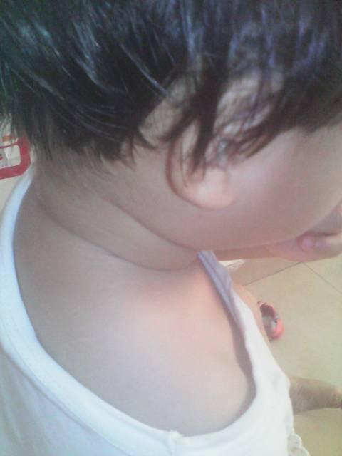 我女儿脖子从出生就多一圈肉,现在一周岁半多了还是这样,是怎么回事啊