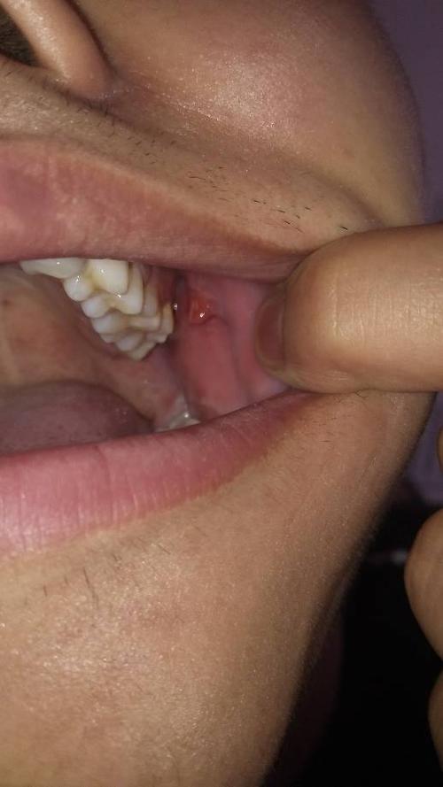 左侧口腔壁长了一块肉 没什么感觉 就是有时吃东西不得劲