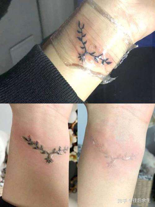 受了半年的罪,可算是把纹身弄淡化到,不怎么看的出来了!