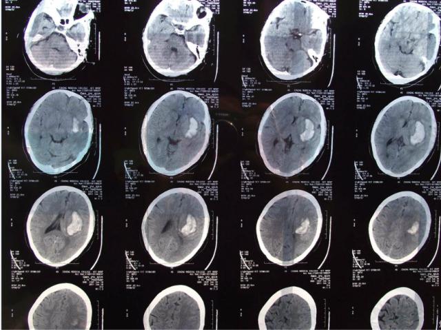 头颅ct解剖与常见出血梗死判读