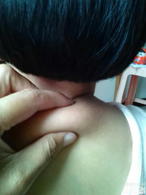 宝宝十九个月脖子后面像是肉多的突出