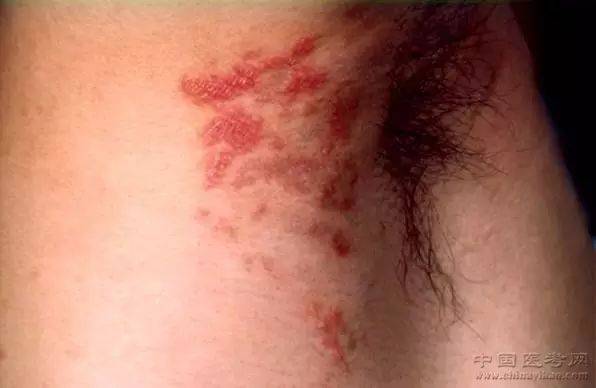 腰背部斑疹性二期梅毒疹