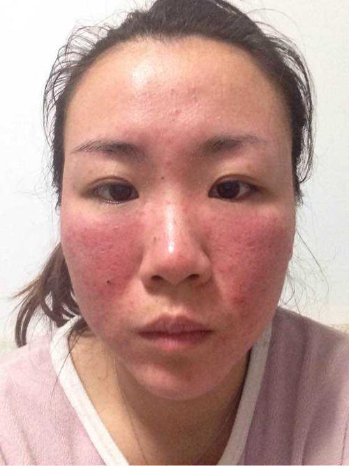 激素脸的治疗方法,如何修复才能彻底好