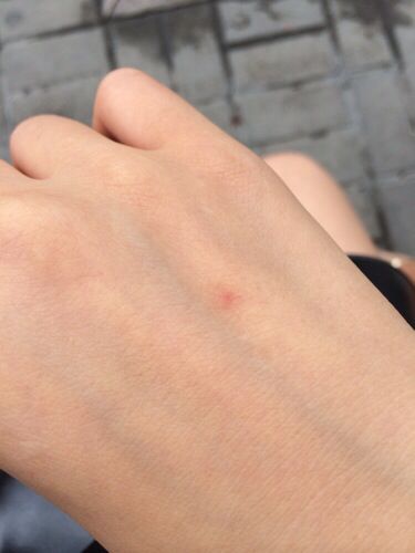 搓破了会一直出血,但红点还会在.一喝酒就特别