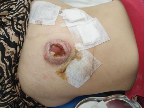 成功为直肠癌晚期t4bn2am1a患者在腹腔镜下行姑息性乙状结肠造瘘术