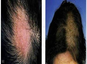 头皮糠疹,头皮糠疹如何治疗,头皮糠疹症状-皮肤性病科