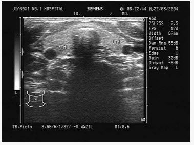 如图,正常甲状腺中部横切面的超声声像图,中央气管环状软骨前方组织为