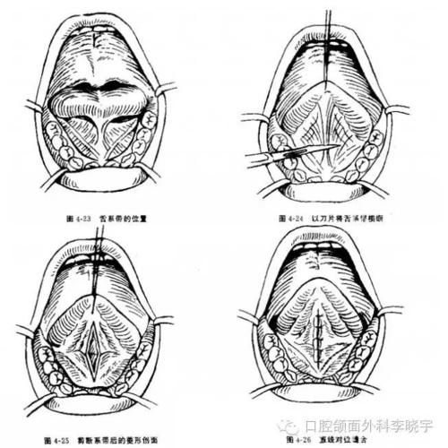矫正舌系带过短