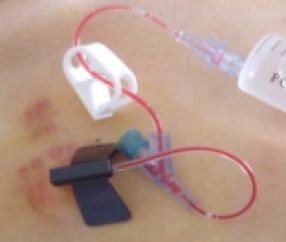 超全!一文掌握输液港使用及维护流程