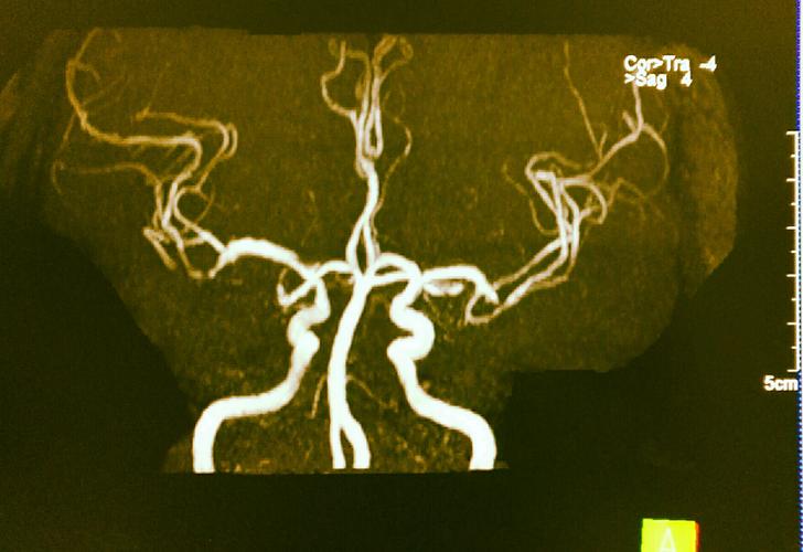 头部血管成像(mra)