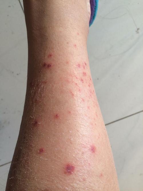 上百度搜了下症状,和艾滋病的初期症状很