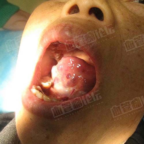 来自周碧舌头口腔成人血管畸形海绵状血管瘤患者日记