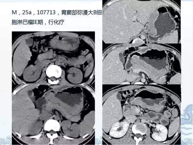 ct检查及诊断攻略——胃癌,结直肠癌