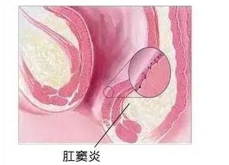 这是排便感受器持续受炎症刺激所致.