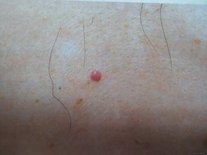 血管瘤怎么治疗