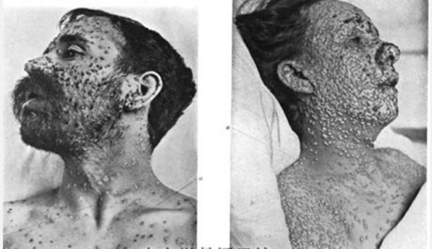 天花介绍_天花病因_天花治疗_天花医院医生_有来医生