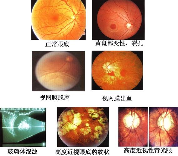 高度近视为什么容易导致眼底黄斑部出血,发生病变?