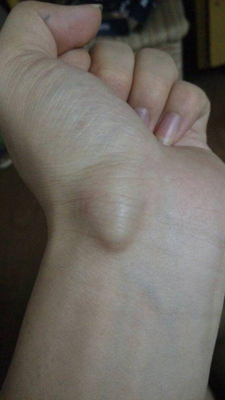 左手手腕长了一个硬疙瘩,去医院看医生,医生说两种方法,一个切掉,但要