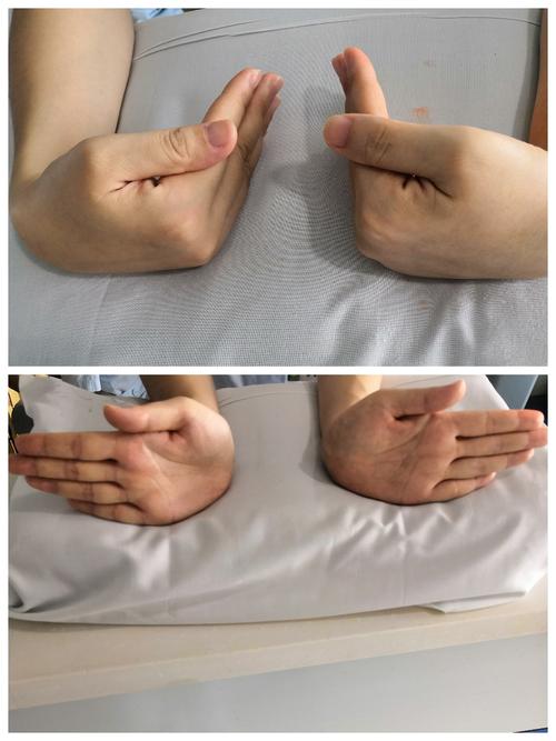 手腕骨折康复训练