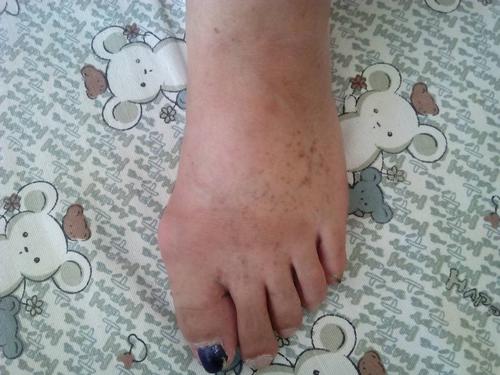 问:这是脚背上的小红点,起了十多年了有,时而起时而下去的~不疼不痒的