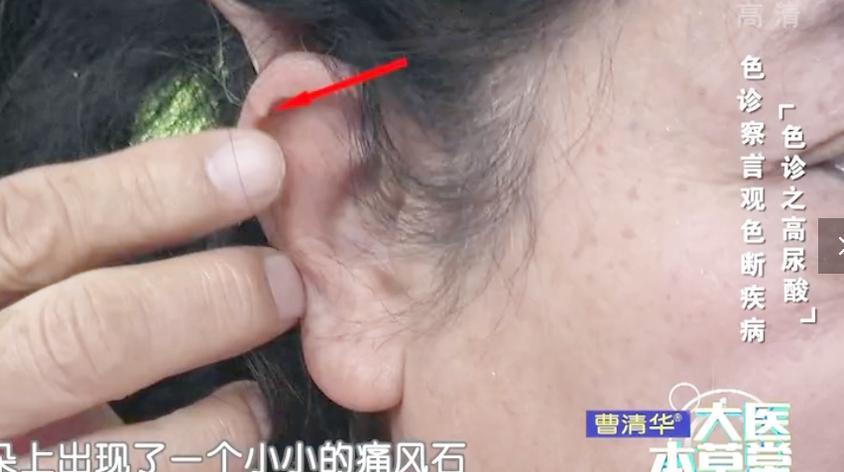 耳朵上有痛风石怎么办视频在线观看 - 西瓜视频