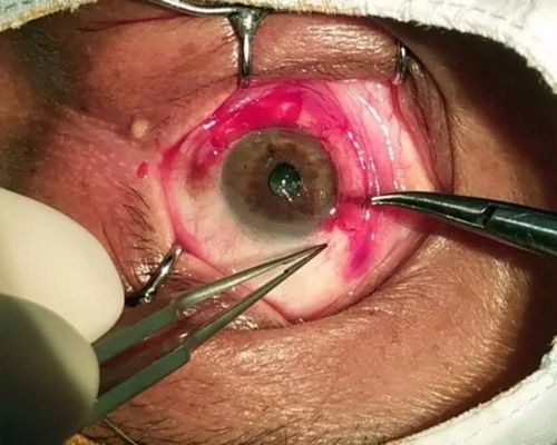 康燕可翼状胬肉手术全过程