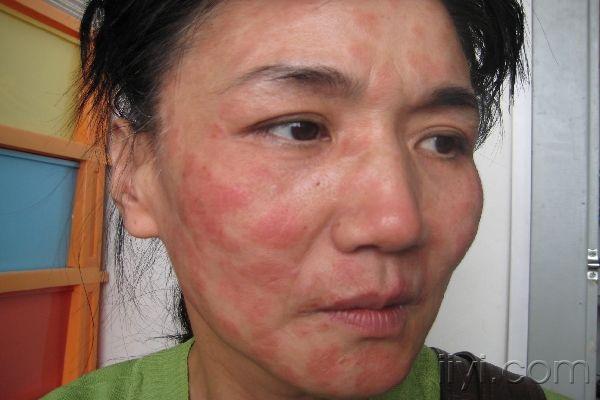 注册x  面部红斑半年左右,轻度瘙痒,不伴发热,脱发,关节痛等症状