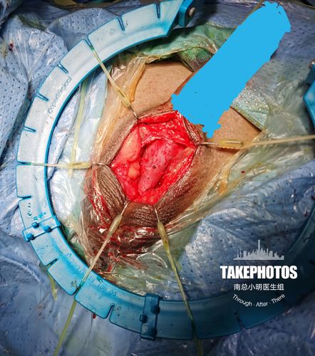 2020年华南地区第一例人工尿道括约肌植入手术成功