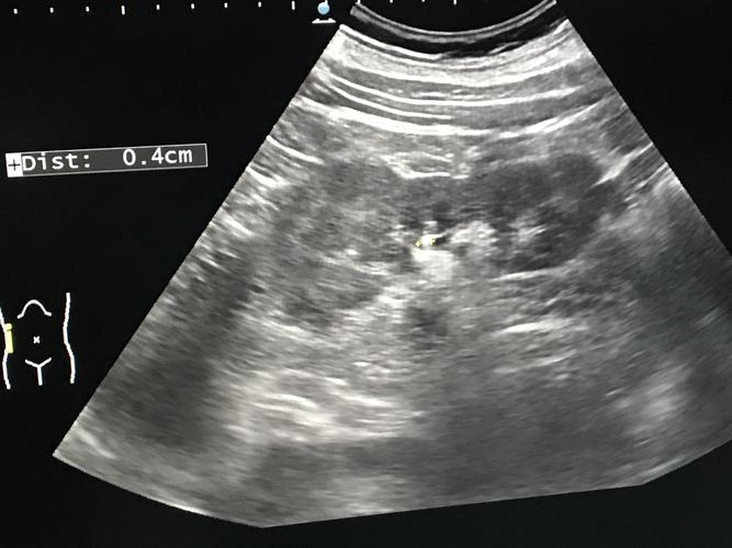 1.3超声右肾结石0.4cm