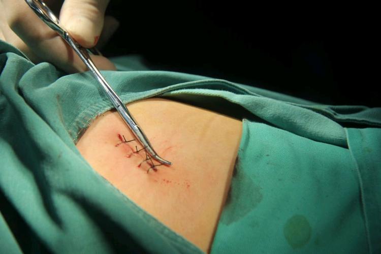 腔镜下精索静脉曲张高位结扎术比传统的手术有创伤小,出血少等,术后