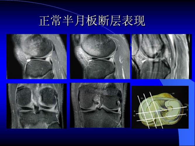 膝关节的鉴别诊断 半月板损伤 mri规范化扫描 mri磁共振片子 南昌大学