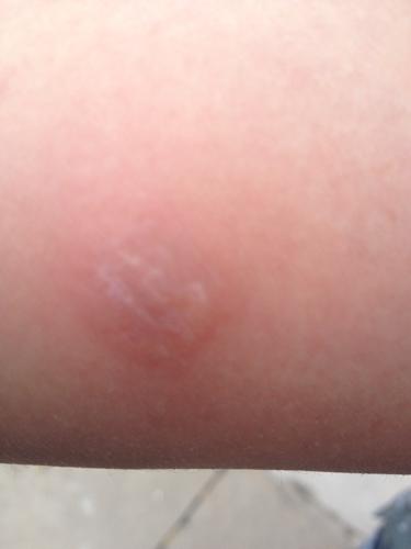 请问注射结核杆菌皮试液后三日皮球出现红肿痛大水泡