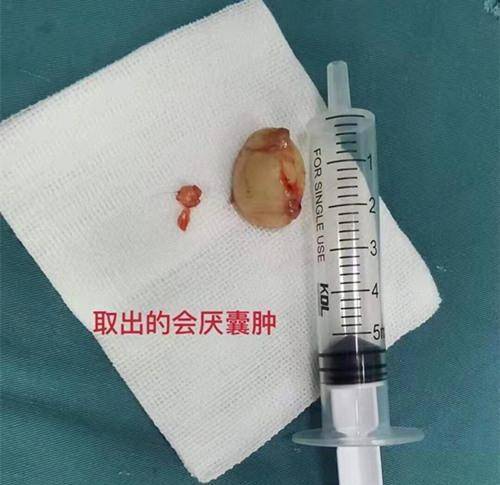 "急性子"吃饭狼吞虎咽,吃出2厘米大会厌囊肿"卡喉"