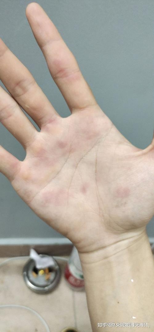手掌脚底有红斑,很痒加一点刺痛感,不可能梅毒吧!