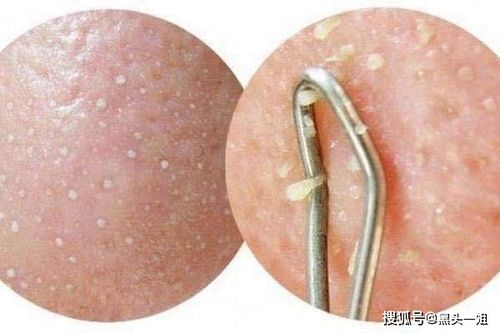 男生该怎样去黑头呀?