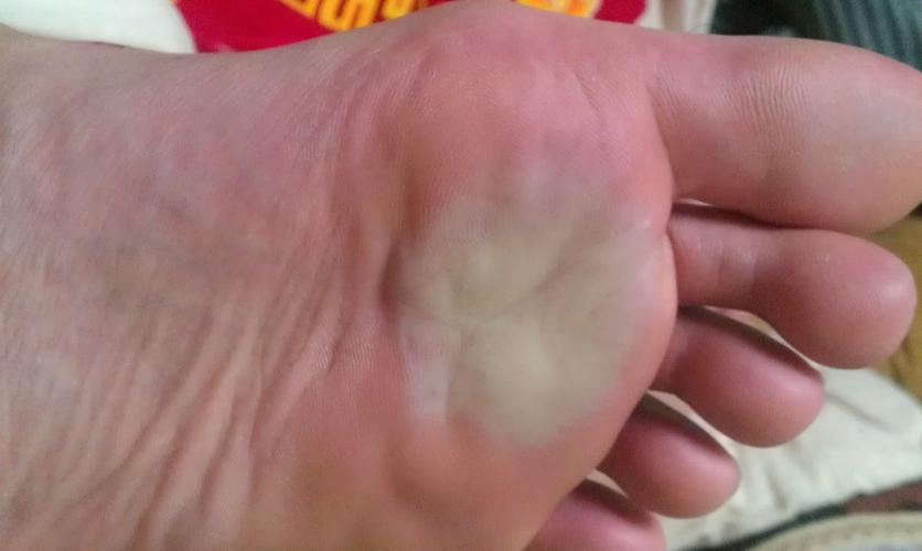 一直觉得脚底下有异物!请问这是咋了?