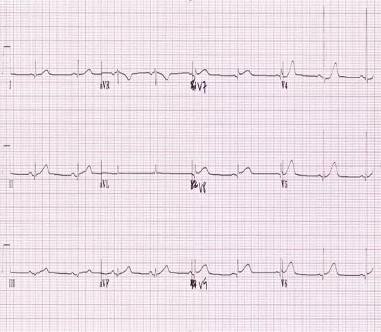 心电图与心脏超声里面的"正后壁"究竟指的哪个位置?
