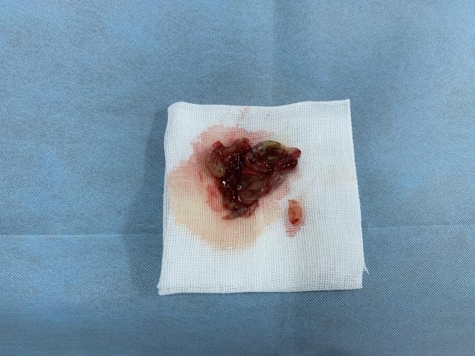 聊聊鼻息肉和鼻窦炎的那些事儿