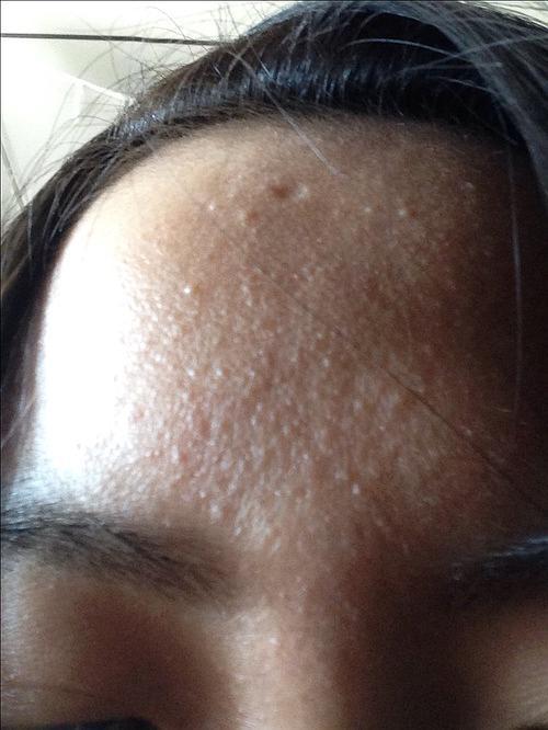 这是不是闭合粉刺?求大神(密集恐惧症者慎入)